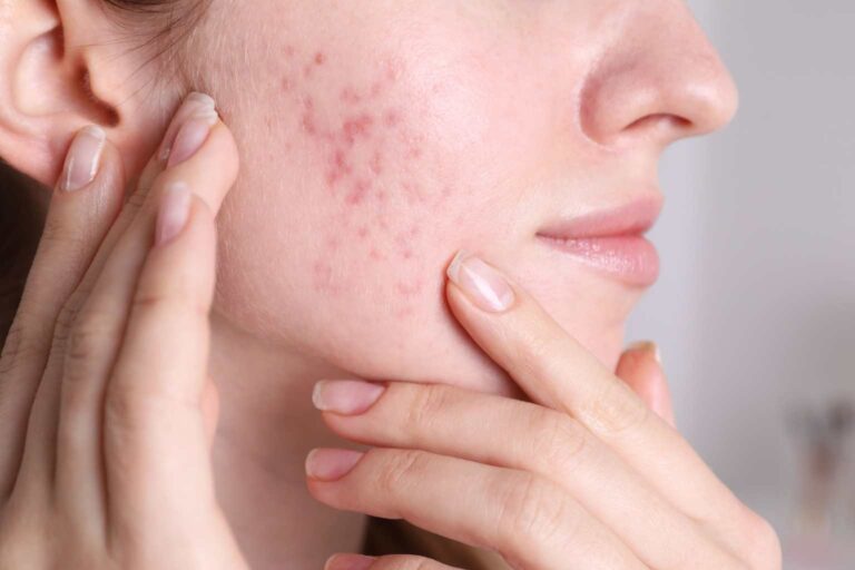acné de la mujer