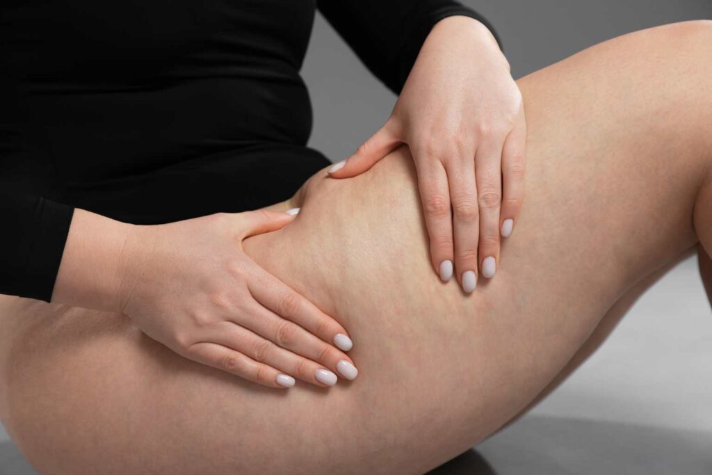 Curso de Nutrición para celulitis